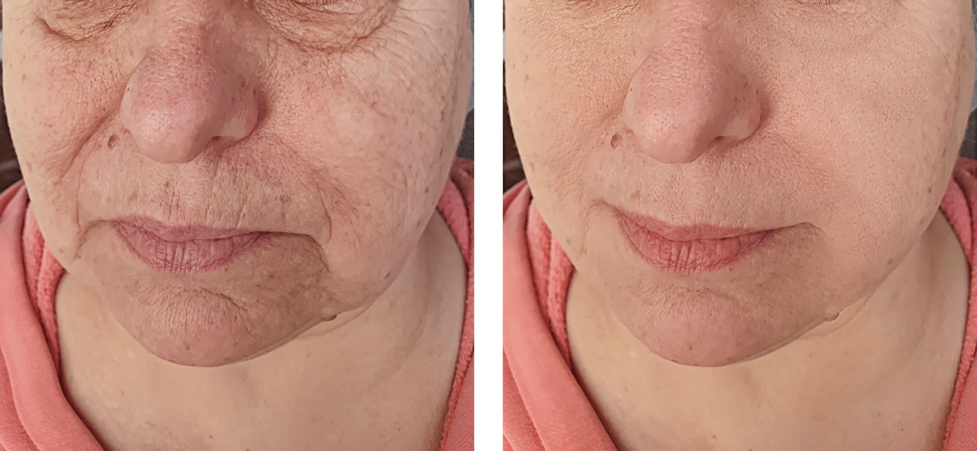 Elderly woman  face wrinkles   after procedures
